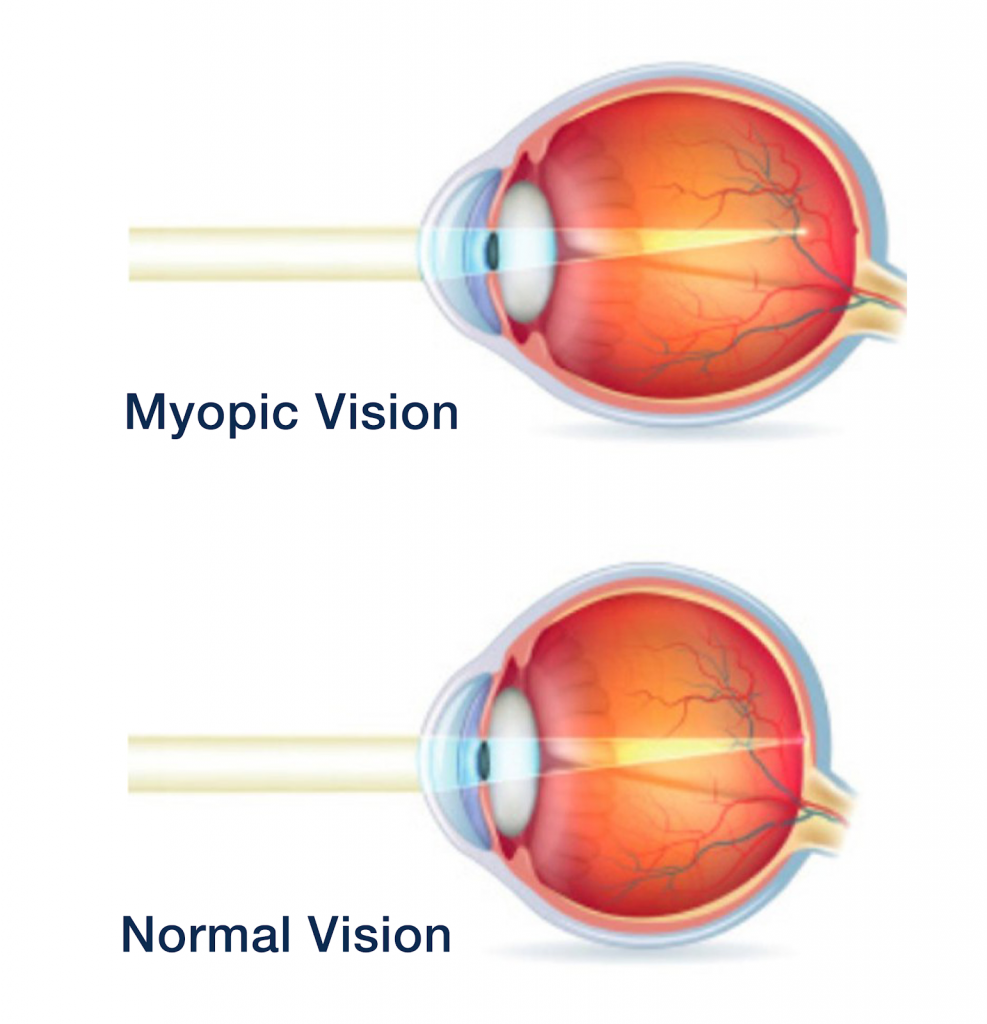 what is myopia