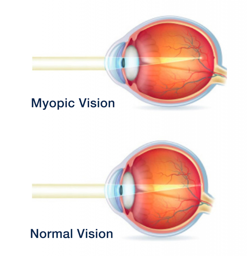 Reducing Myopia Can myopia actually be reduced