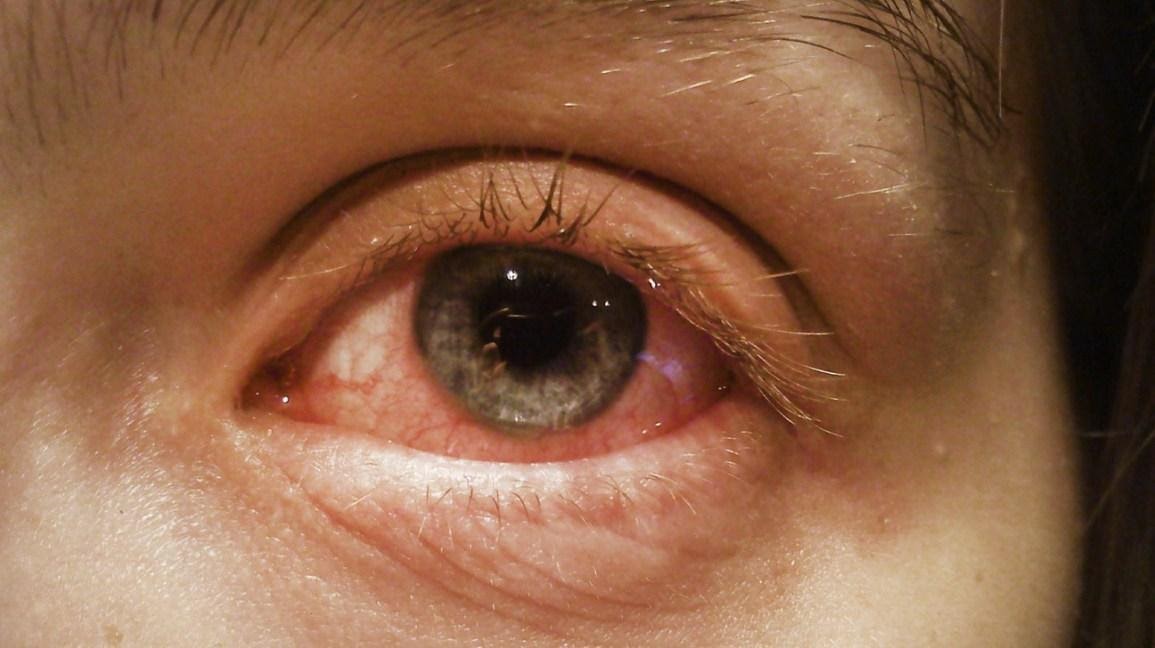 pink eye