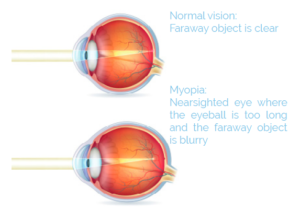 Staring at The Screen is Causing That Strain in Your Eyes