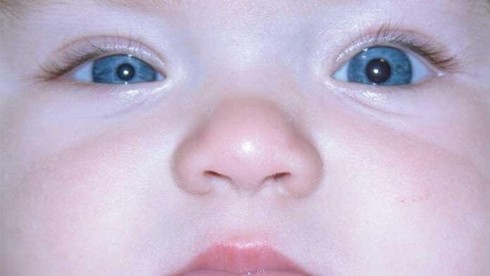 unequal pupil size in infants
