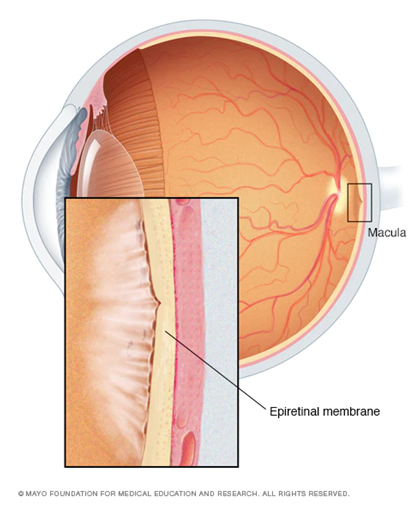 Structure of the eye showing an epiretinal membrane