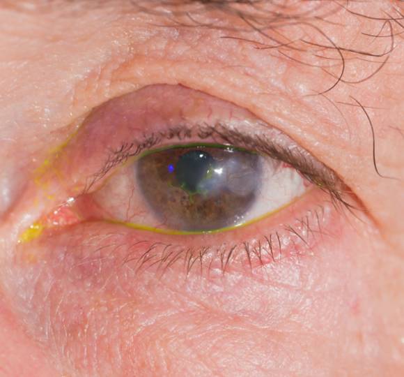 herpes simplex under eye