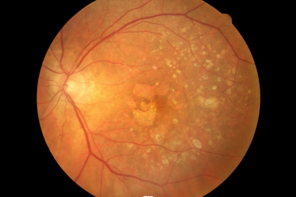 A retinal photo of atrophic (or dry) late-stage age-related macular degeneration, showing areas of central atrophy