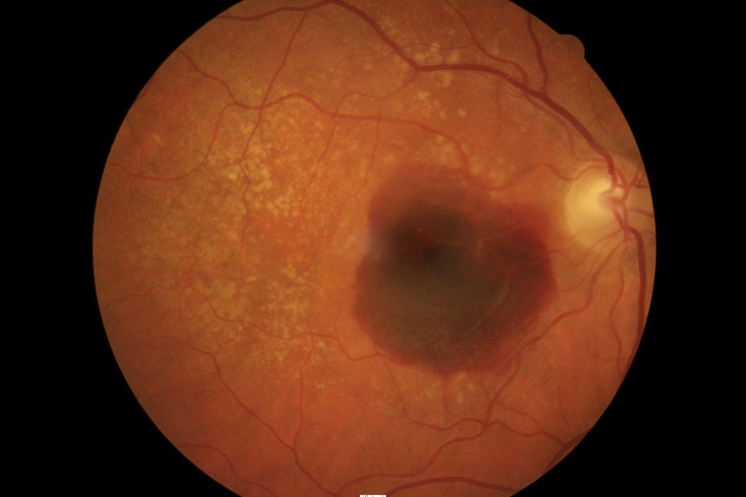 A retinal photo of neovascular (or wet) late-stage age-related macular degeneration, showing a large bleed
