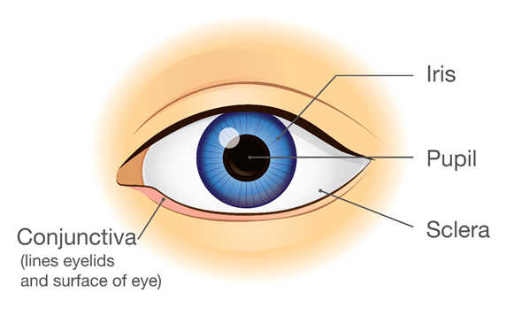 subconjunctival haemorrhage