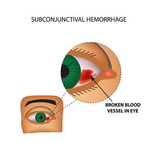 subconjunctival haemorrhage