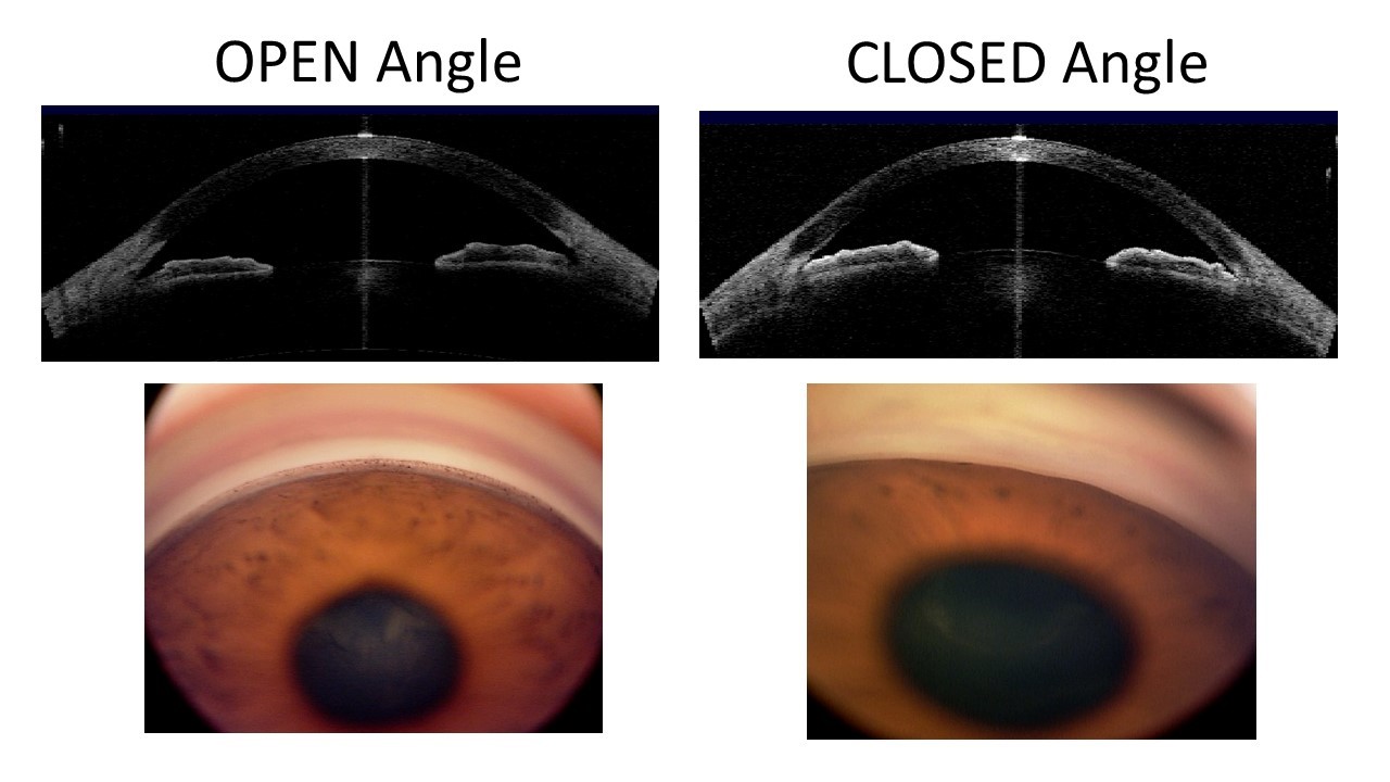 narrow angle eye condition