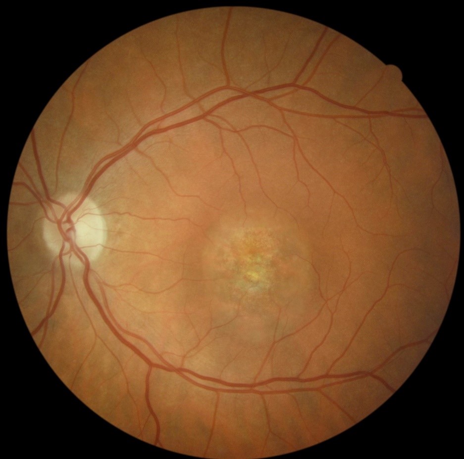 Macular Dystrophy