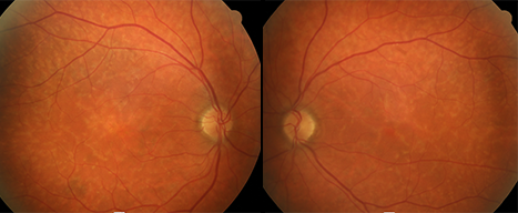 Macular Dystrophies