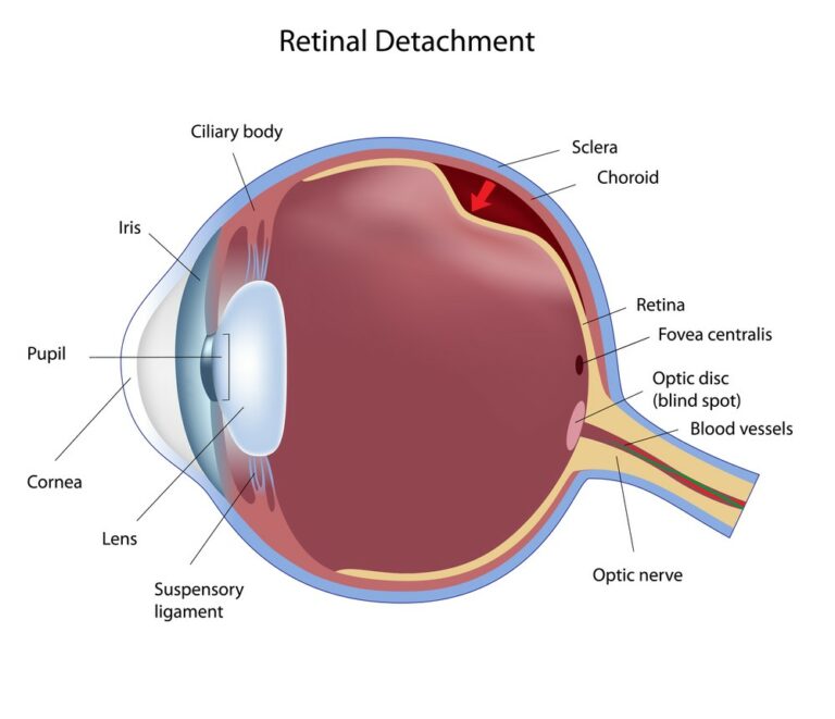 Retinal detachment diagram