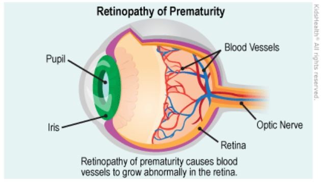 Retinopathy of prematurity