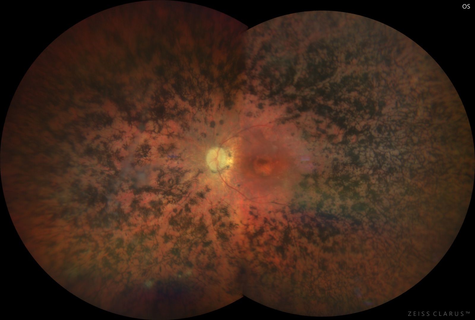 retinitis pigmentosa