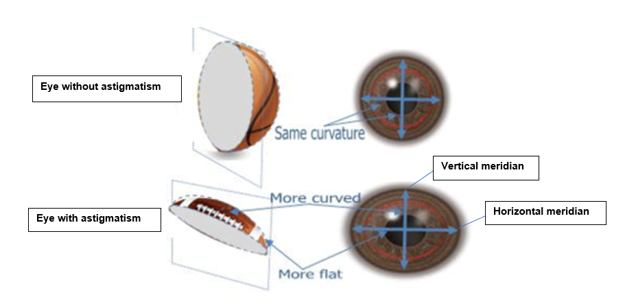 Astigmatism | What is it, Causes and Treatment