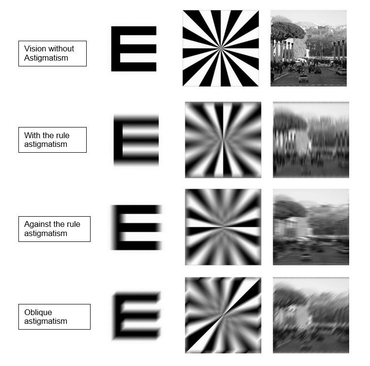 Astigmatism | What is it, Causes and Treatment