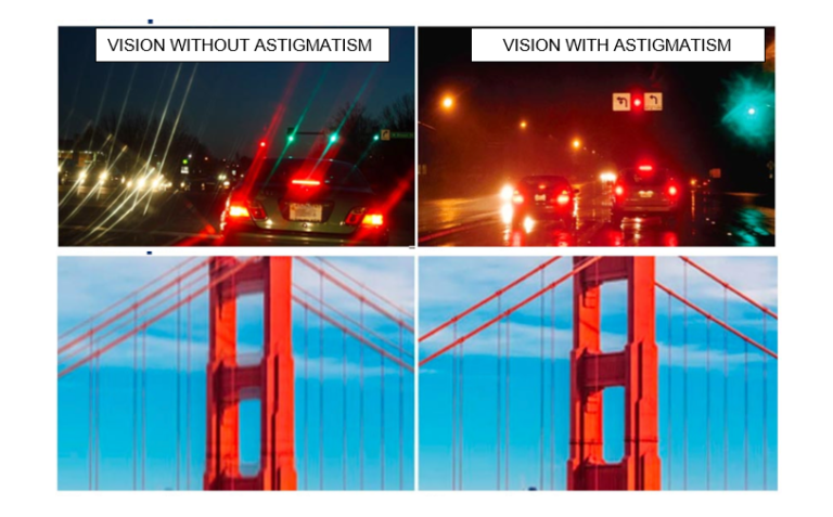 Astigmatism | What is it, Causes and Treatment