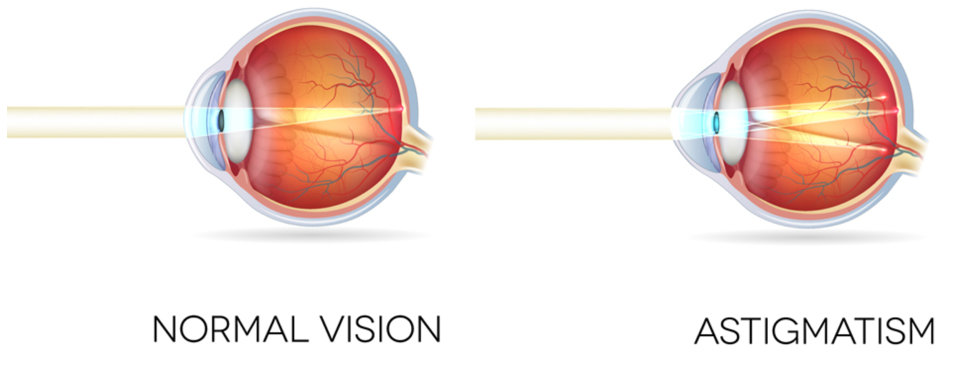 can having astigmatism cause light sensitivity