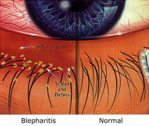 blepharitis