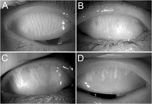 Blepharitis - What is it, Causes and Treatment