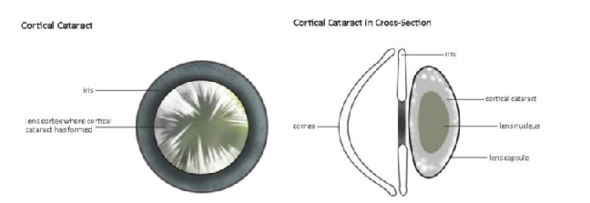 cortical cataract