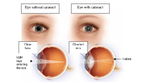 Cataract - What Is It, Causes And Treatment 