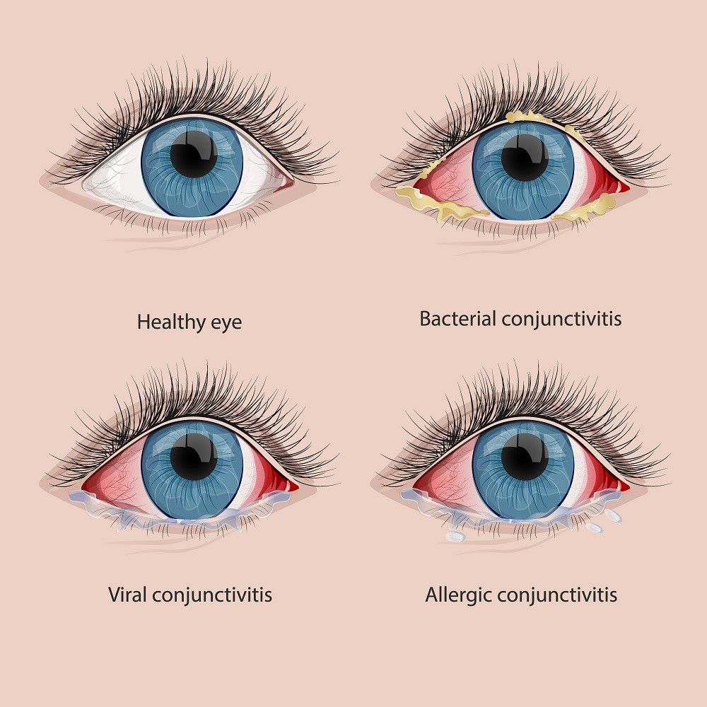 Uveitis Vs Conjunctivitis