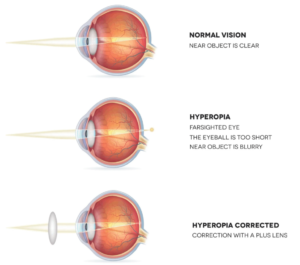 Hypermetropia What Is It Causes And Treatment