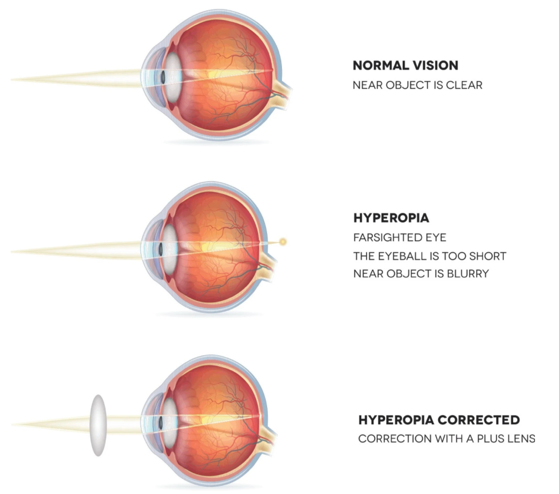 setup-build-on-threaten-convex-lens-hypermetropia-bad-luck-gem-rescue