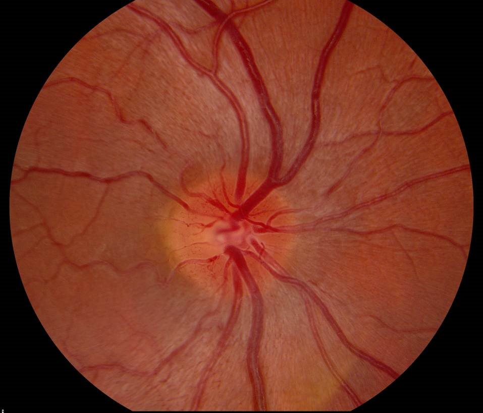 Leber hereditary optic neuropathy
