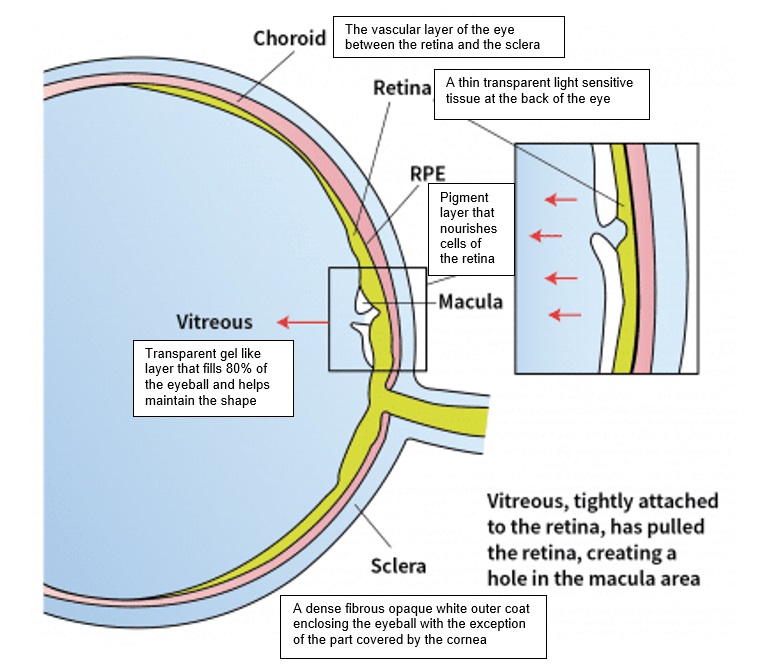 Macular hole