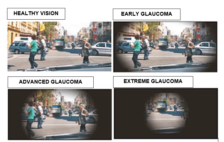 Open Angle Glaucoma - What is it, Causes and Treatment. | Eye Health