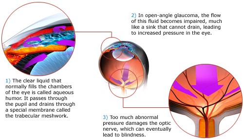 Open angle glaucoma