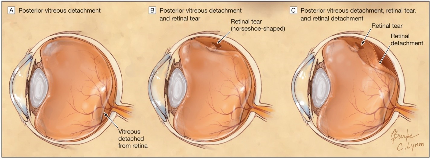 retinal detachment causes