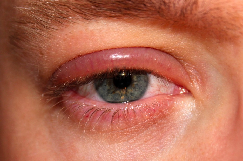 Swollen Eyes And Eyelids: Why And How To Treat Them