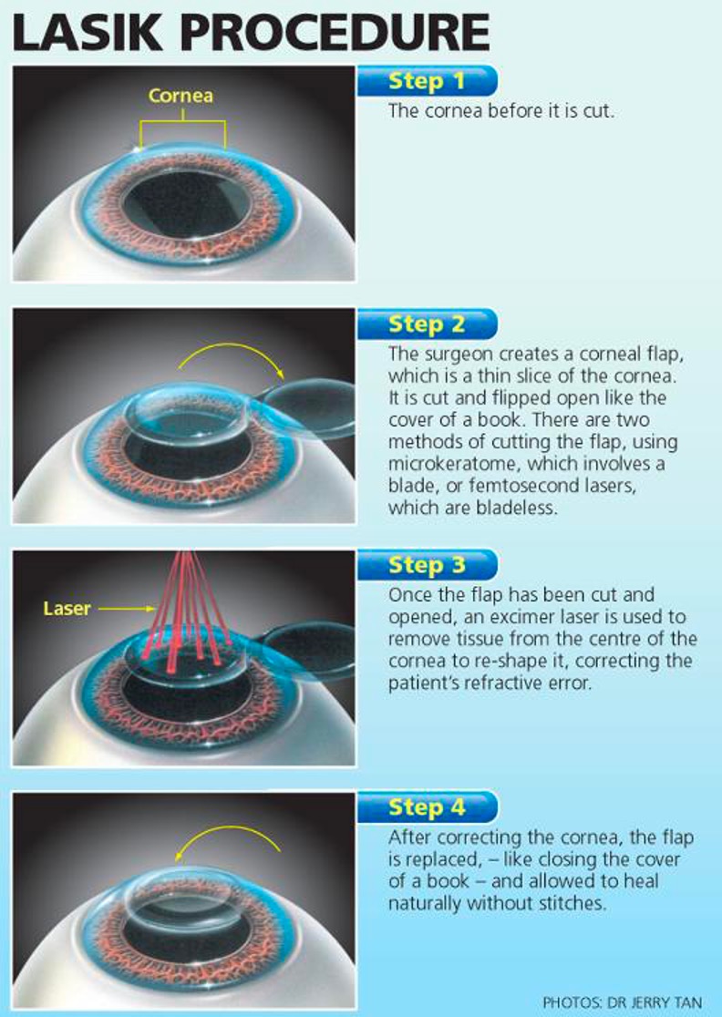 Laser Eye Surgery Risks