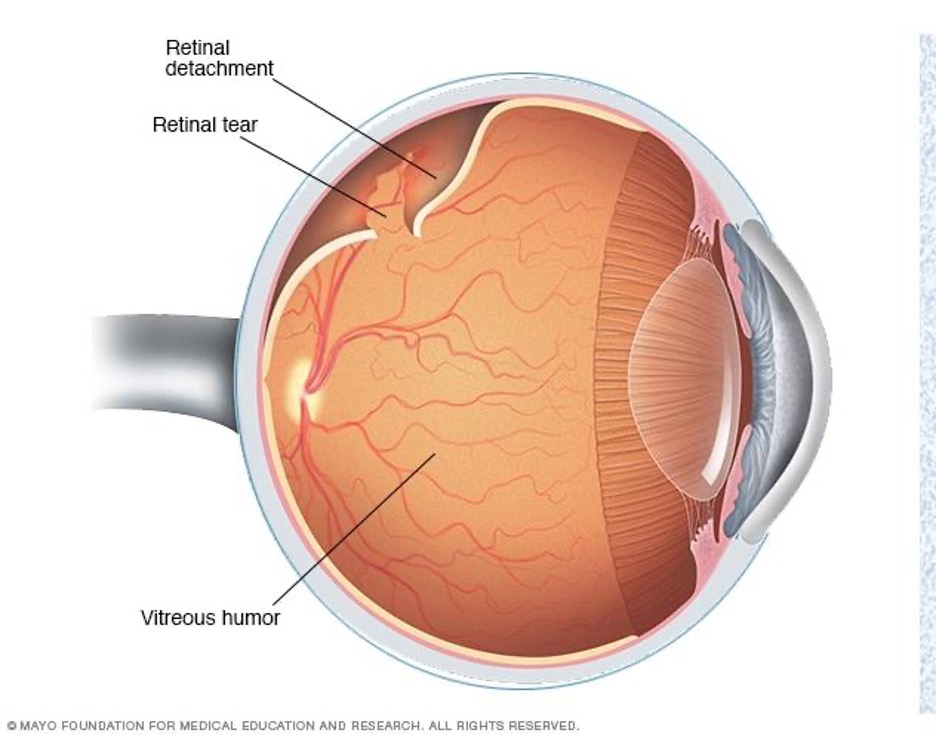 new research on eye floaters