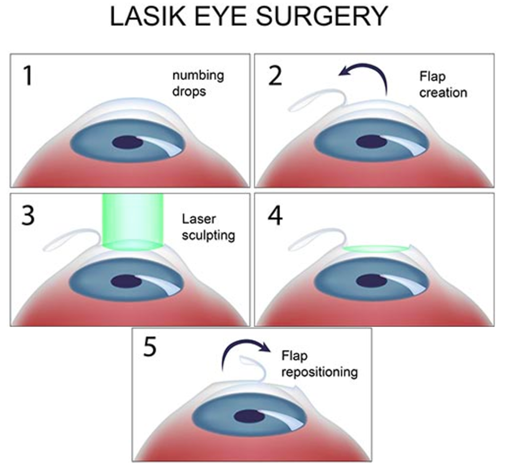 LASIK eye surgery for astigmatism | What you need to know