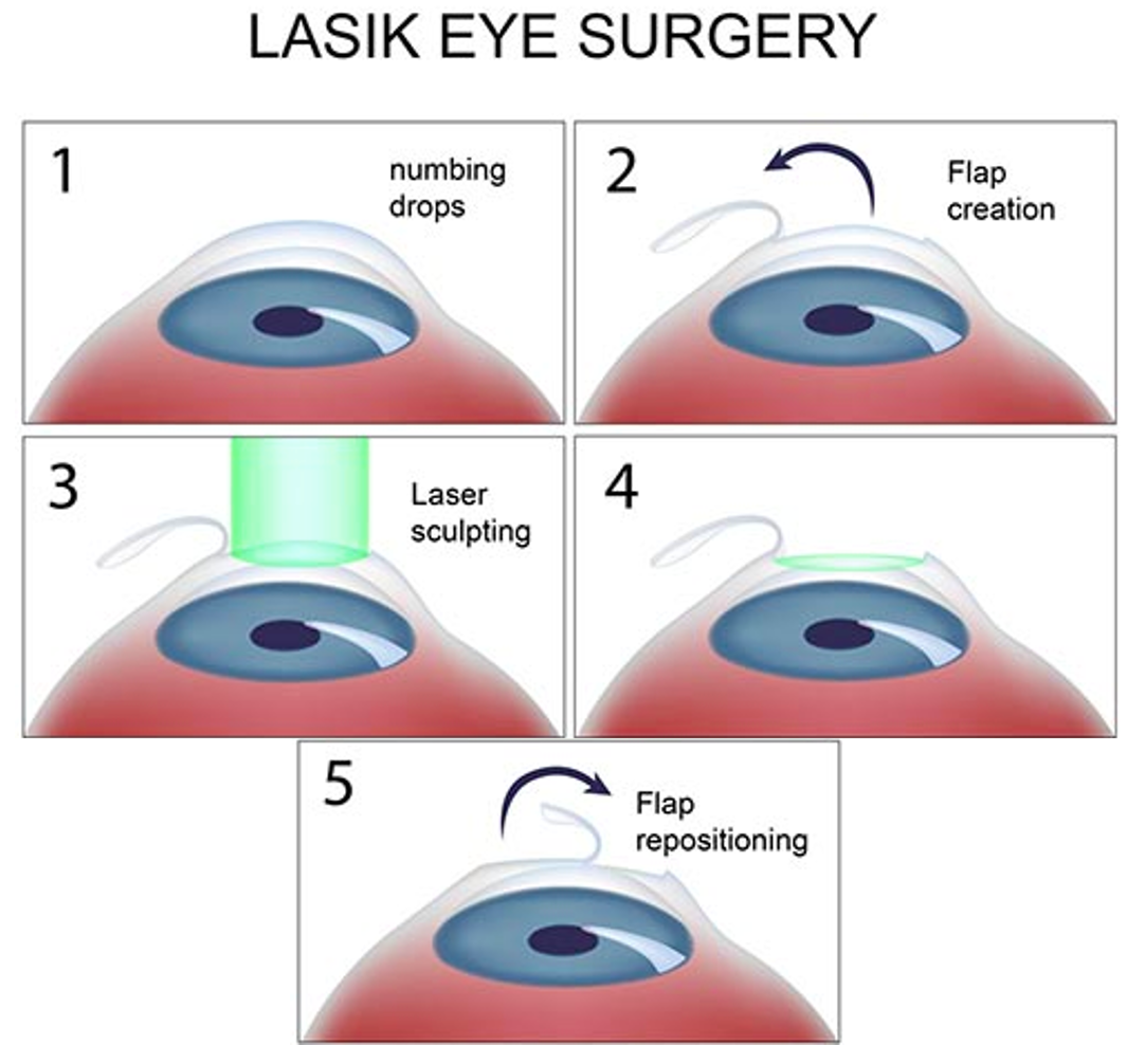 lasik for astigmatism