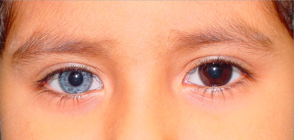 Heterochromia - American Academy of Ophthalmology