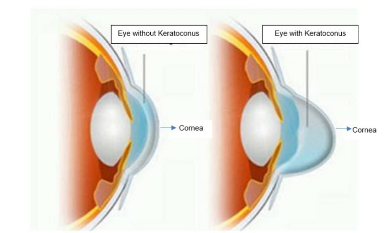 Keratoconus What Is It Causes And Treatment