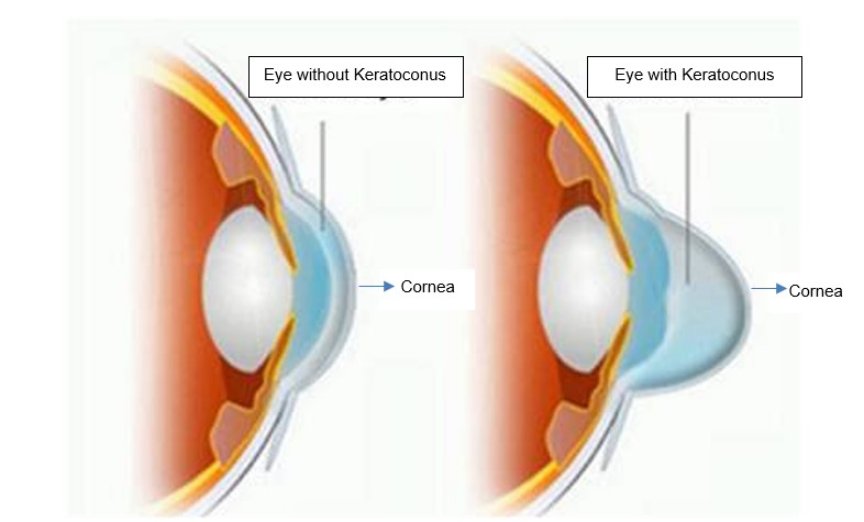 keratoconus