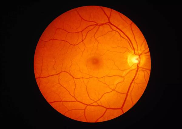 macular degeneration