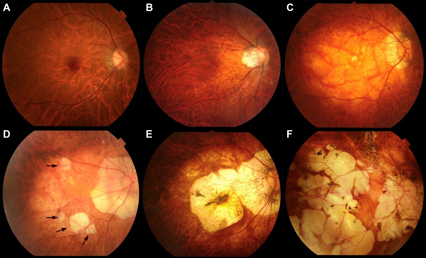 Myopic Macular Degeneration 2 