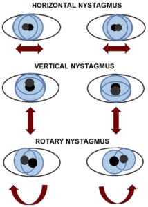 Nystagmus | What is it, Causes and Treatment