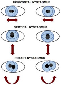 Nystagmus