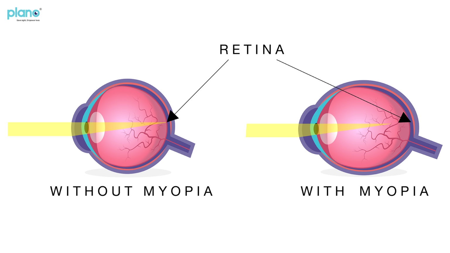 Myopia Nearsightedness Or Short Sightedness A Global Epidemic 7870