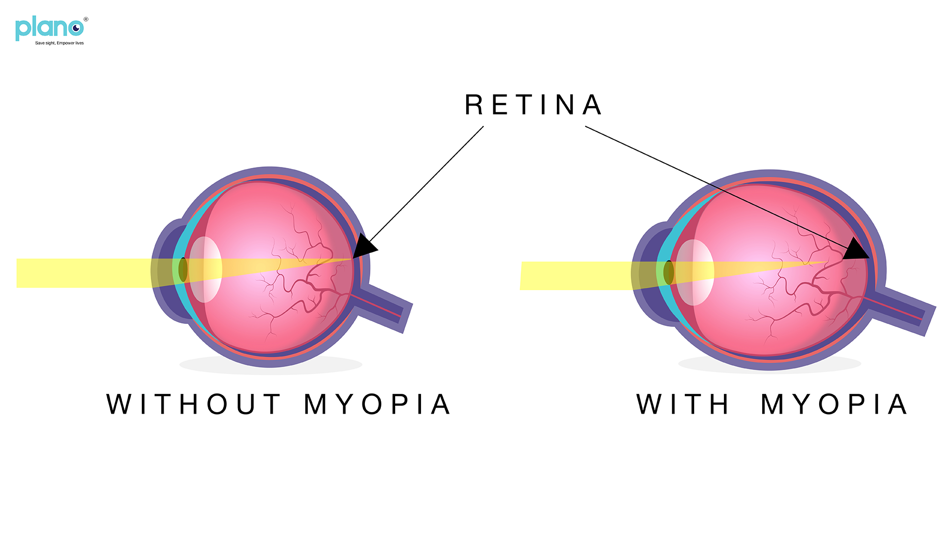 What Are the Different Types of Myopia?