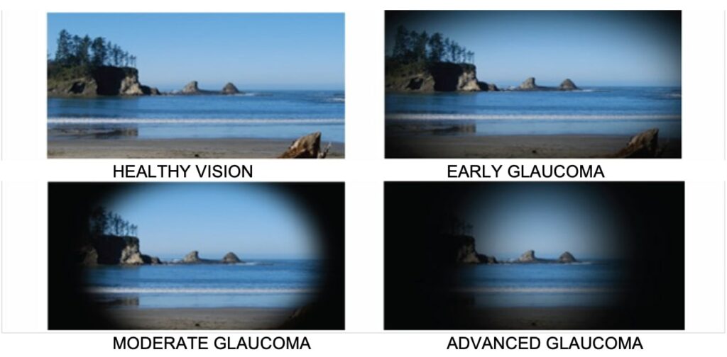 What are the glaucoma symptoms? Discover more! | Plano Eye Health