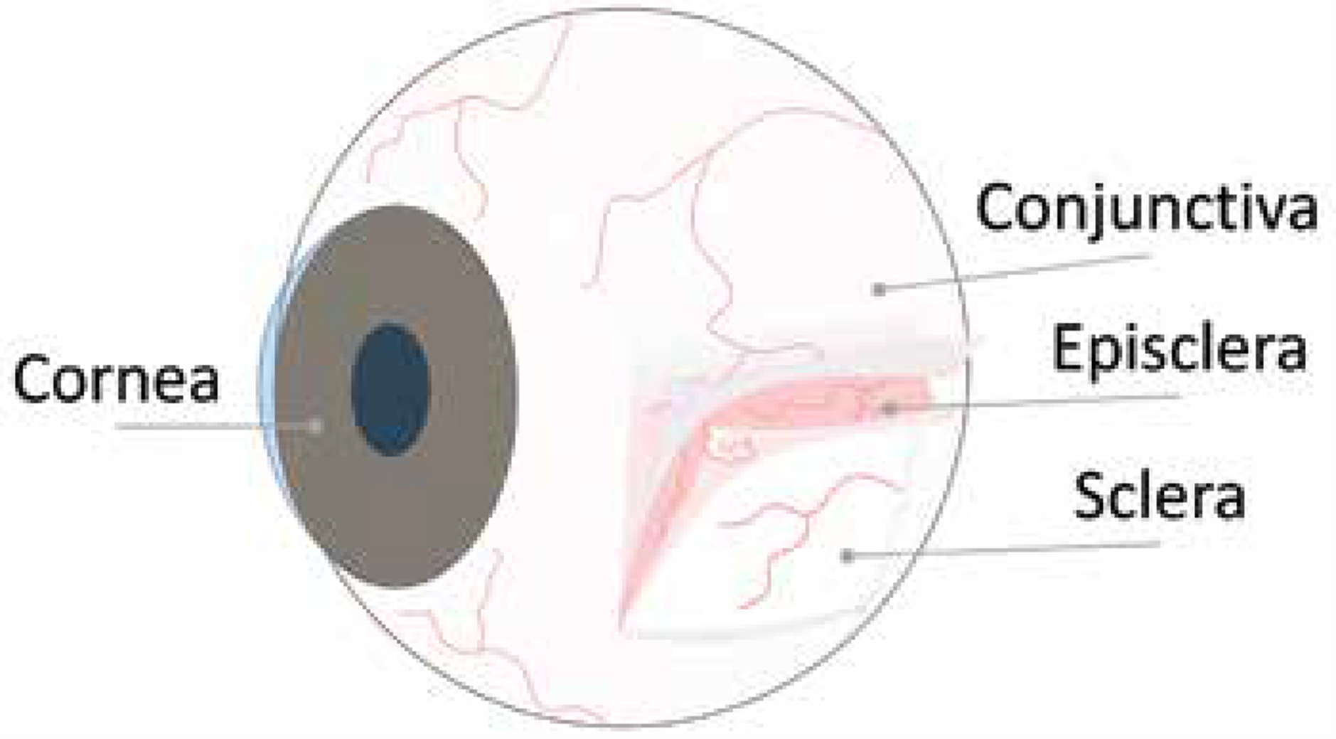 Episcleritis | Plano | Save sight. Empower lives.