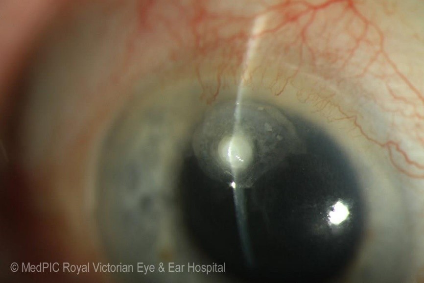 microbial keratitis